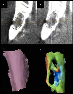 Hydrogel-chitosan and polylactic acid-polycaprolactone bioengineered scaffolds for reconstruction of mandibular defects: a preclinical in vivo study with assessment of translationally relevant aspects